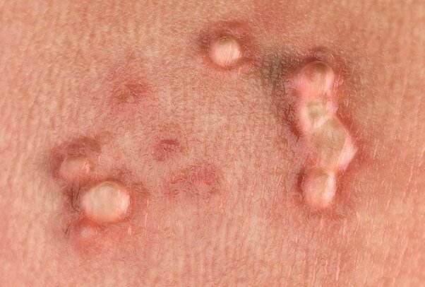 hpv-warts-722x406-1-e1748497719111